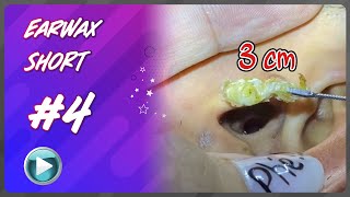 So awful ASMR EARWAX [upl. by Nitsej]