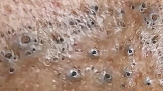 Blackheads amp Whiteheads Satisfying Removal 0048 [upl. by Kcirdet19]