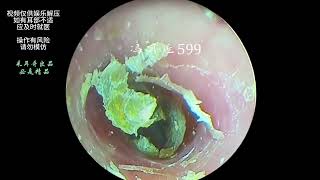 Hard cerumen removal dry pieces on the ear canal and eardrum [upl. by Nylssej]