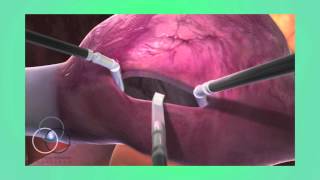 Atrial Septal Defect Repair at SSM Heart Institute [upl. by Ellicec]