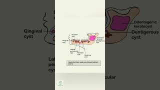 ODONTOGENIC AND NON ODONTOGENIC CYSTdental dentalschool mouth [upl. by Ignace988]