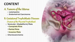 Female genital tumors II Uterus and Trophoblast شرح محاضرة [upl. by Adneral]