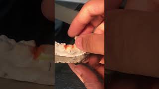 Lower right premolar tooth covercap dentalshorts trendingshorts youtubeshorts [upl. by Bryan419]