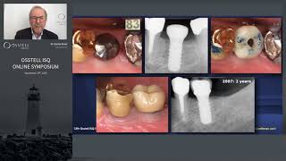 Basic study to establish ISQ as a standard method in daily practice [upl. by Eletnahs235]