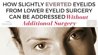 Ectropion and Lower Lid Retraction after Eyelid Surgery  Diagnosing Severity and Need for Revision [upl. by Medor821]