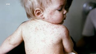 Your child has a viral rash but which one is it Here’s a comparison [upl. by Lallage]