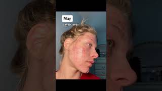 Shocking acne scars results in under one year acnescars acne explore [upl. by Orips]