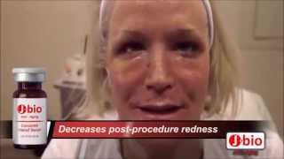 CO2 Laser Skin Tightening PostProcedure Treatment [upl. by Sudoeht]