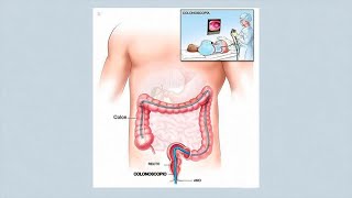 ¿Cómo se realiza una colonoscopia y una gastroscopia [upl. by Dace]