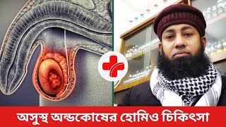 অসুস্থ অন্ডকোষের হোমিও চিকিৎসা। [upl. by Hsaka]