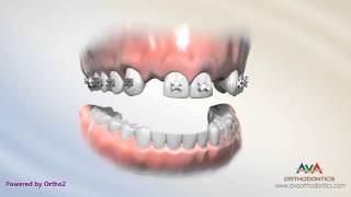 Orthodontic Treatment for Missing Lateral Incisor  Braces on Fake Teeth [upl. by Elsinore43]