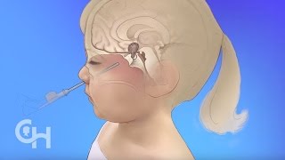 Endoscopic Neurosurgery for Brain Tumors in Children [upl. by Mcclish]