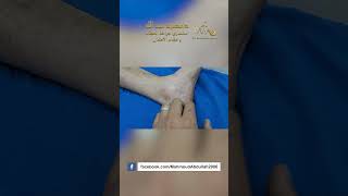 Haglunds disease short البروز العظمي الخلفي للكعب [upl. by Nelyaw]