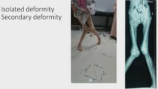 Deformity Correction part 3  G Hosny [upl. by Gambell791]