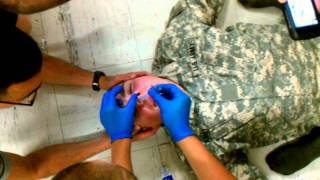 Nasopharyngeal Airway Insertion NPA [upl. by Anemolif472]