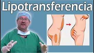 TODO SOBRE la LIPOTRANSFERENCIA 👙 transferencia a GLÚTEOS y MAMAS ❤️ El Dr ALBERTO CALVO RESPONDE [upl. by Pearle399]