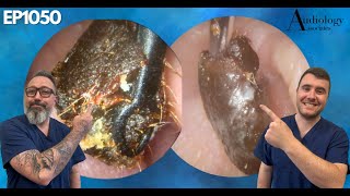 THICK EAR WAX PLUG REMOVED FROM PATIENTS EAR  EP1050 [upl. by Jacinta686]