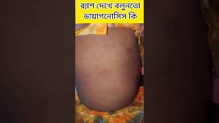 Maculopapular rash measles trustmedical shortsviral shortsvideo shorts youtubeshorts [upl. by Sedecrem]