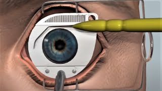 LASIK eye surgery  3D animation [upl. by Nileak]