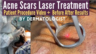 Acne Scars Laser Treatment  CO2 Laser Treatment For Acne Scars  Dermatologist  Dr Sunil Kothiwala [upl. by Ultima750]