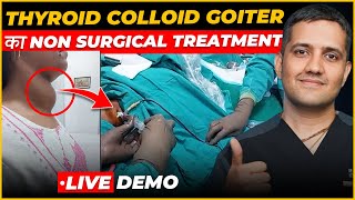 Thyroid Colloid Cyst  Experience of Treating Big Swelling Neck  Dr Gaurav Gangwani IR [upl. by Pence]