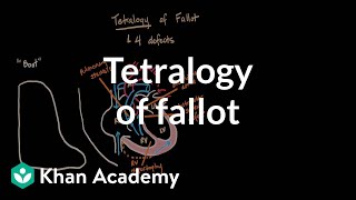 Tetralogy of fallot  Circulatory System and Disease  NCLEXRN  Khan Academy [upl. by Aillicsirp]