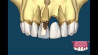 Bridge Vs Dental Implant [upl. by Halimeda430]