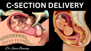 Caesarean Delivery CSection Complete Animation Video for Mommies to be [upl. by Eittik]