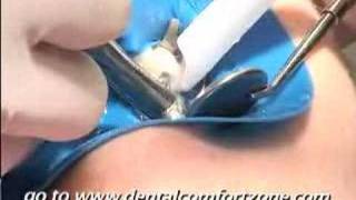 Root Canal Retreatment Demonstration Short Version [upl. by Kerby]