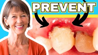 How To Treat Gingivitis And Gum Recession At Home [upl. by Sirapal]