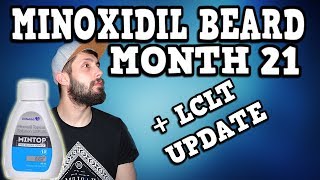 Minoxidil Beard Growth Results  LCLT UPDATE  Month 21  TheJourneyContinues [upl. by Rosati]