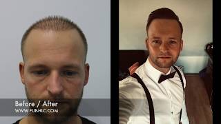 Hair Transplant Before and after Repair with 4300 Grafts  Unbelievable Result [upl. by Dlorah302]