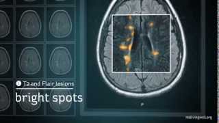 Multiple Sclerosis Understanding Your MRI [upl. by Waldman407]