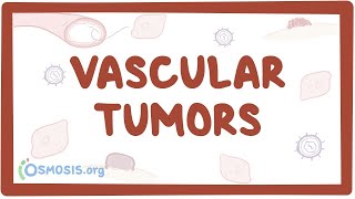 Vascular tumors kaposi hemangioma angiosarcoma  causes amp symptoms [upl. by Ahsiaa]