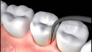 Animation of Laser Periodontal Therapy [upl. by Eneloc]