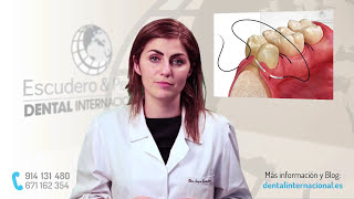 Periodontitis tratamiento · Dental Internacional [upl. by Josselyn]