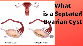 What is a Septated Ovarian Cyst [upl. by Rafaela]