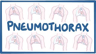 Pneumothorax  causes symptoms diagnosis treatment pathology [upl. by Ees]