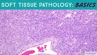 Basic Soft Tissue Pathology Cases Explained by a Sarcoma Pathologist [upl. by Belayneh]