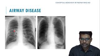 CHEST X RAY IN AIRWAY DISEASE COPD [upl. by Ahtnams32]