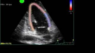 ABNORMAL STRAIN LONGITUDINAL ECHO [upl. by Suryc130]