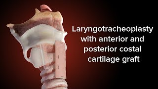 Medical Animation Anterior and Posterior Cricoid Split  Cincinnati Childrens [upl. by Zat968]