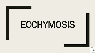 EcchymosisBruise Meaning Treatment [upl. by Lanfri]