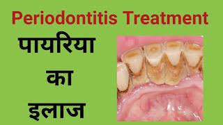 pyorrhea treatmentपायरिया का इलाज कैसे किया जाता हैPeriodontitis treatment pyorrhea medicine [upl. by Eytak980]