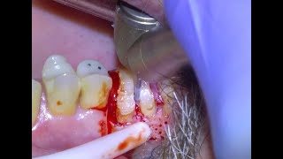 58 Surgical Molar Extraction [upl. by Pederson]