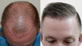 Hair transplant results after 1 year [upl. by Ott]