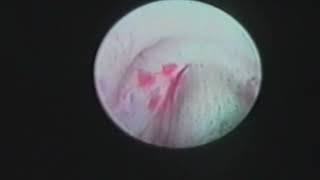 Tratamento de Refluxo vesico ureteral RVU por cistoscopia [upl. by Goines]