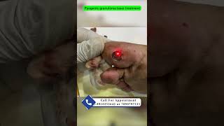 Pyogenic granuloma laser treatment  red bump on sole  pyogenic granuloma का इलाज़ Dr Uttam Lenka [upl. by Araid]