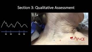 Jugular Venous Pulse Qualitative Assessment [upl. by Joaquin74]