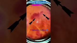 Retinal Hemorrhages  Eales disease  Fundus Photography  Short Video 93 science [upl. by Zimmerman559]